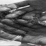 Farmer suffers severe hand injuries in Kparekpare clash with herdsman