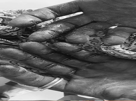 Farmer suffers severe hand injuries in Kparekpare clash with herdsman